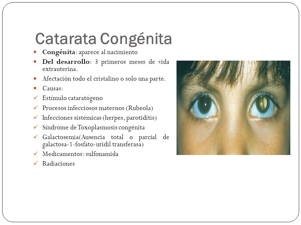 Causas de las cataratas congenitas
